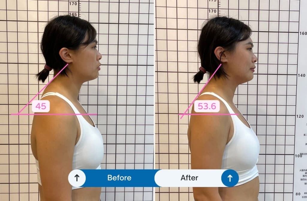 Rounded Shoulders, Hunchback, and Dowager's Hump