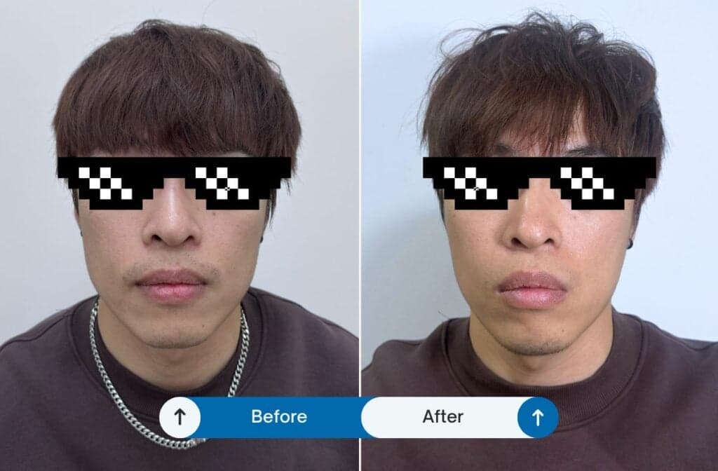 台中肉毒推薦 艾瑞辛診所 2025 04