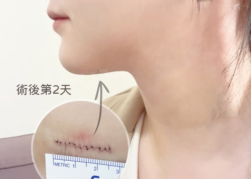 癌症專用止痛藥，術後疤痕幾乎看不到