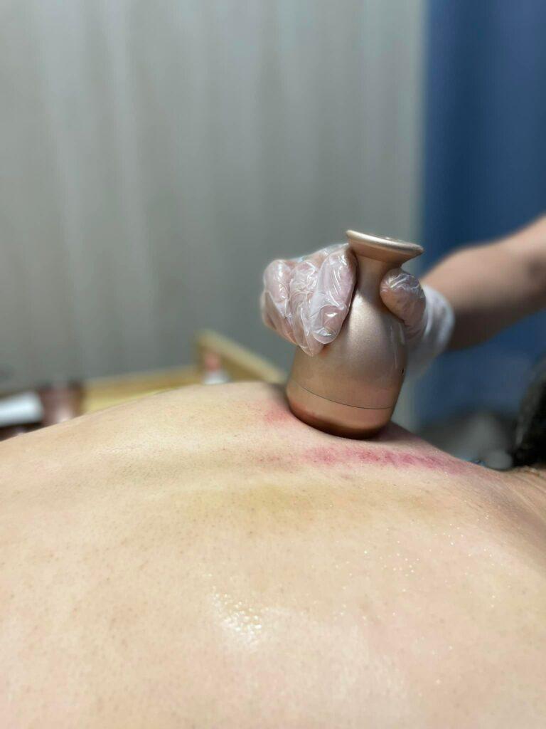台中刮痧推薦 佳㑗艾草溫罐