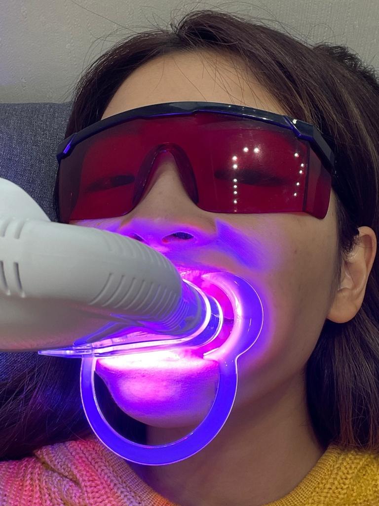 台北牙齒美白推薦 REs Whitening 淨白美齒3