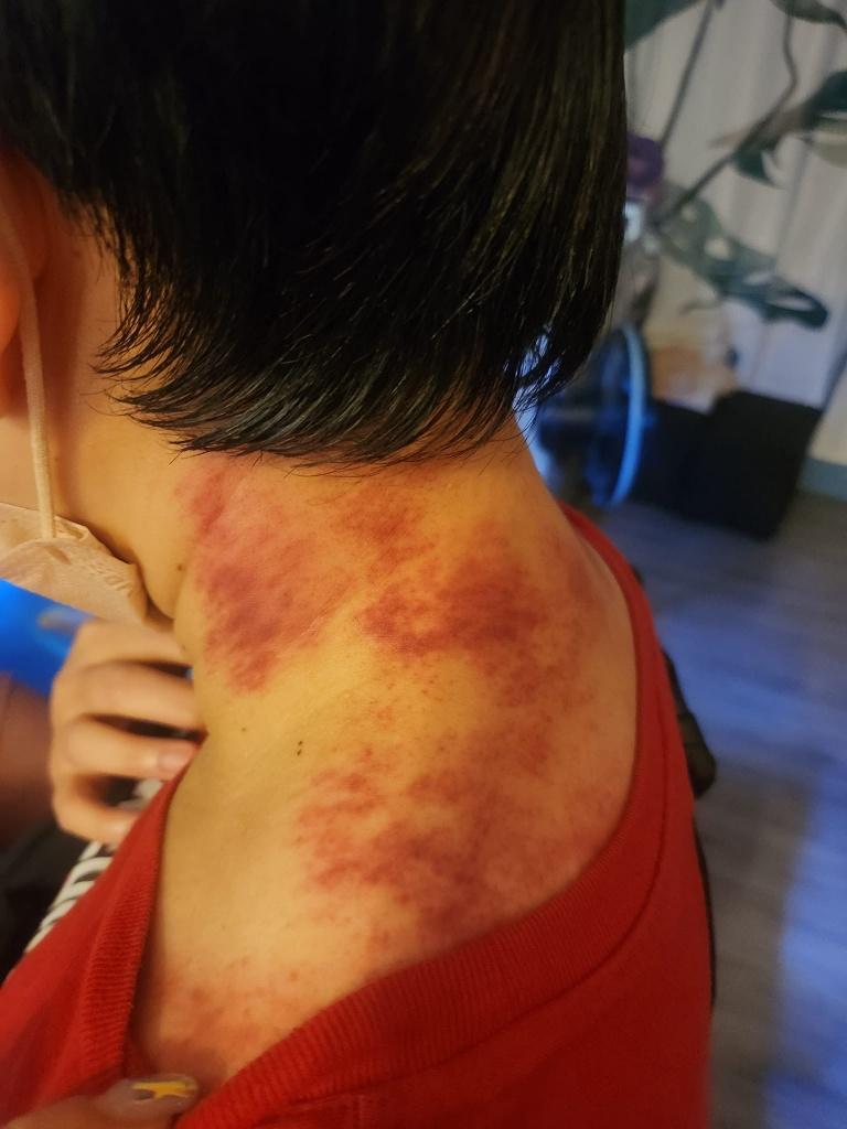 高雄刮痧推薦 樂活刮痧