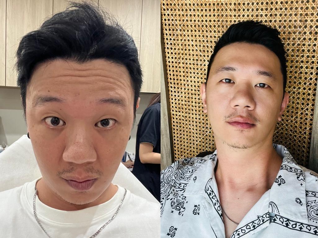 台中肉毒推薦 許惠翔美學診所4