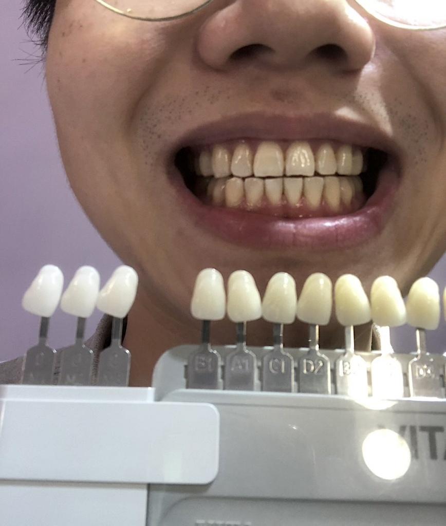 高雄牙齒美白推薦 ビハク審美2