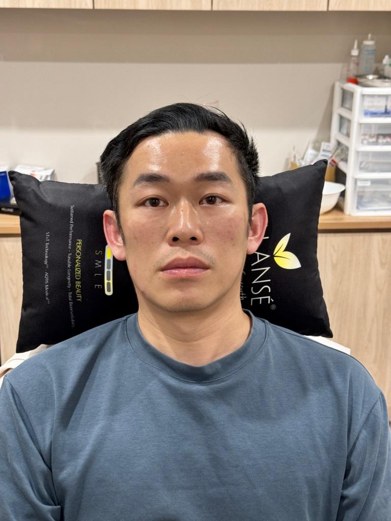 눈물고랑 필러 시술 직후 결과