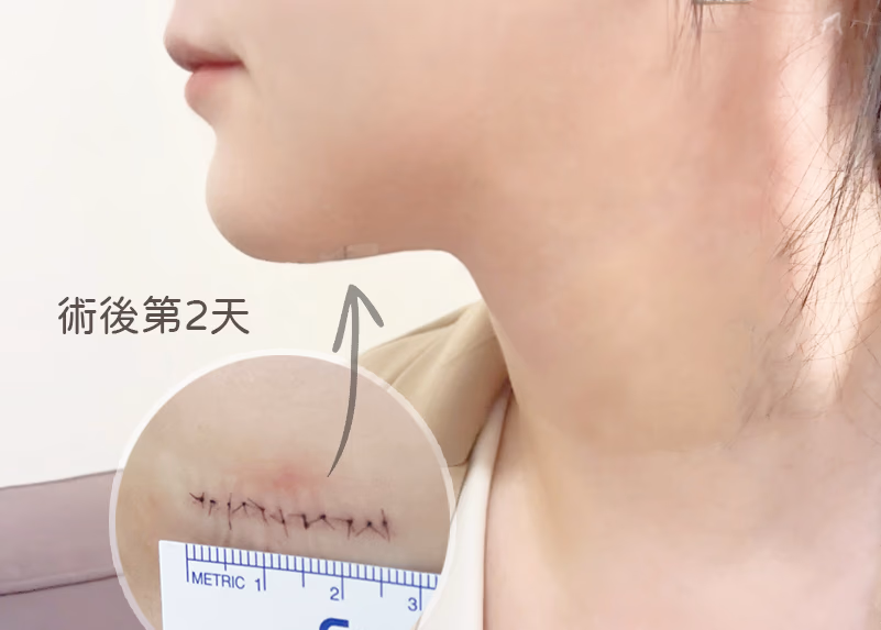 암 환자 전용 진통제, 수술 후 흉터는 거의 보이지 않습니다