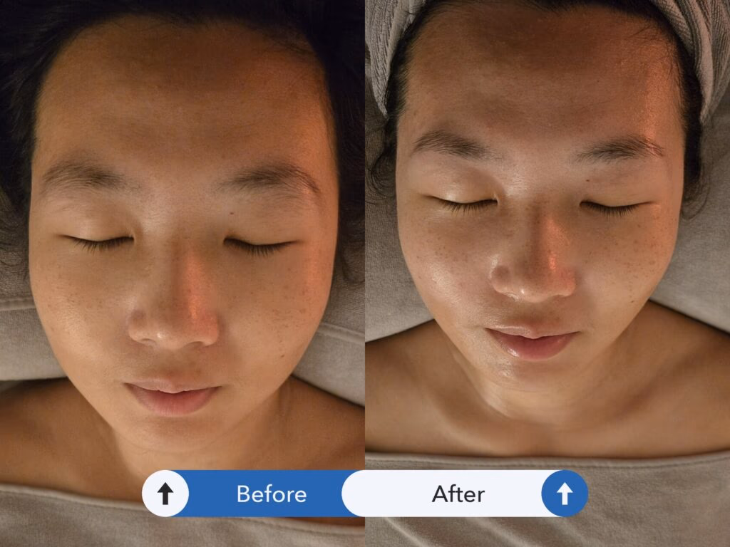 台北撥筋_Ada Beauty Spa_撥筋前後對比