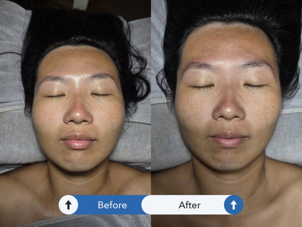台北做臉_Ada Beauty Spa_前後對比