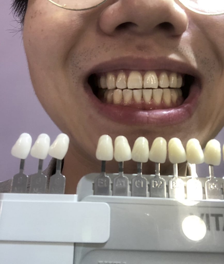 高雄牙齒美白推薦 ビハク審美2