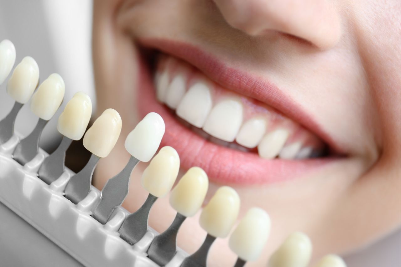 Kaohsiung Teeth Whitening Recommendations
