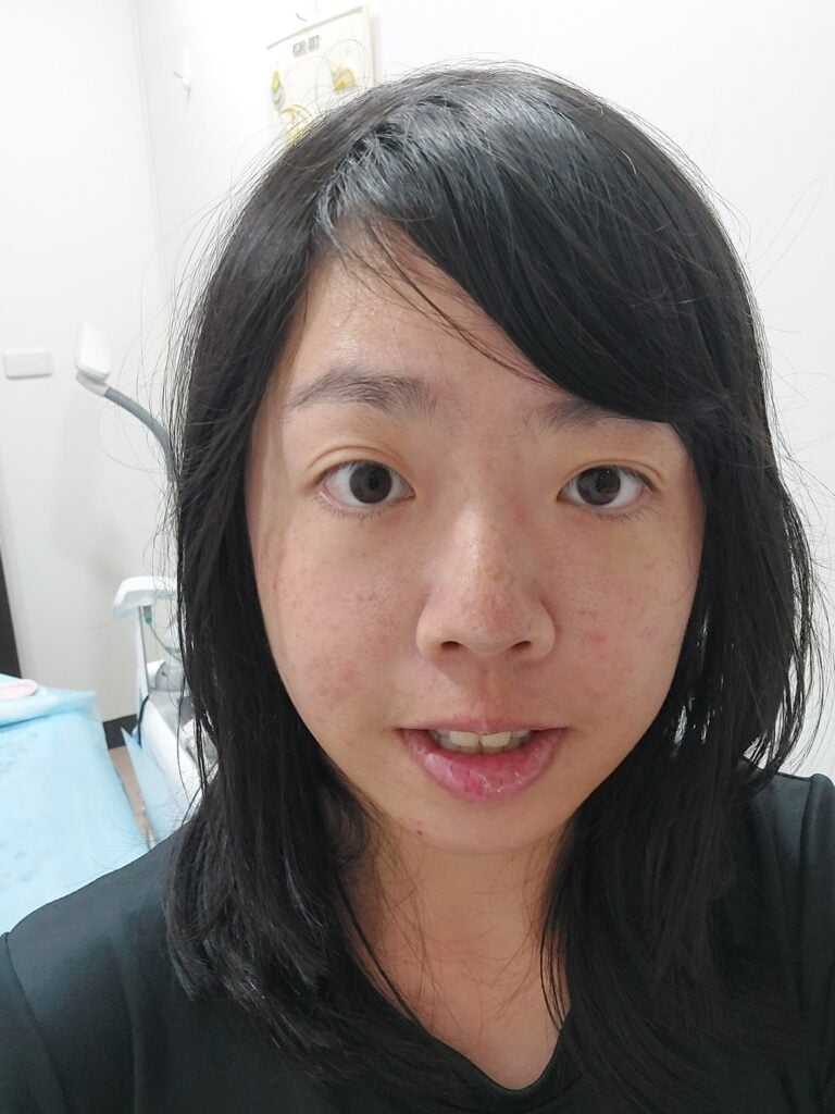 台南皮秒雷射 約菲爾健康美學診所 03