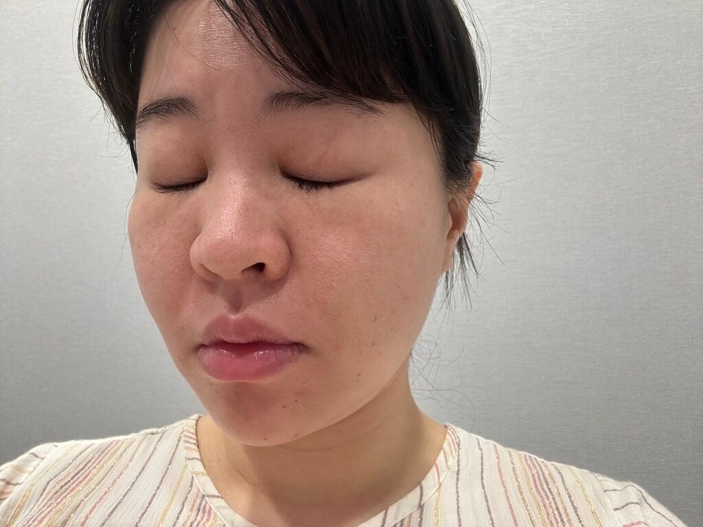 台南雷射皮秒 漾格爾皮膚科醫美診所 03