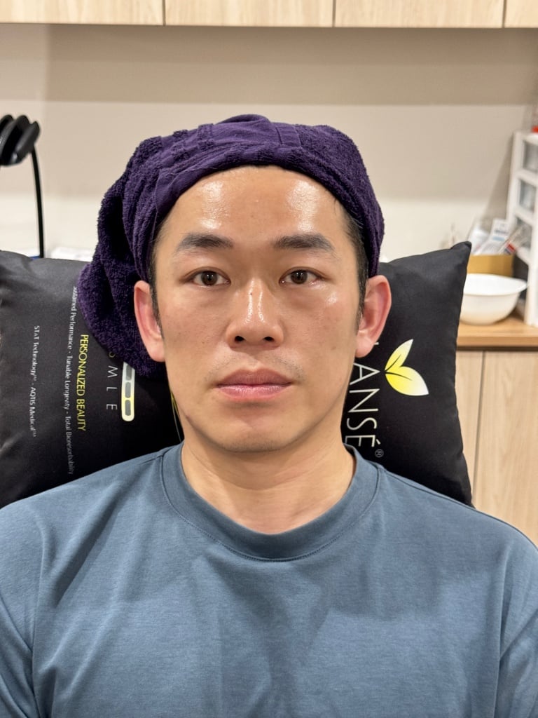 【許惠翔美學診所評價】南屯醫美消眼袋專家！絕不失敗的洢蓮絲淚溝填補 27