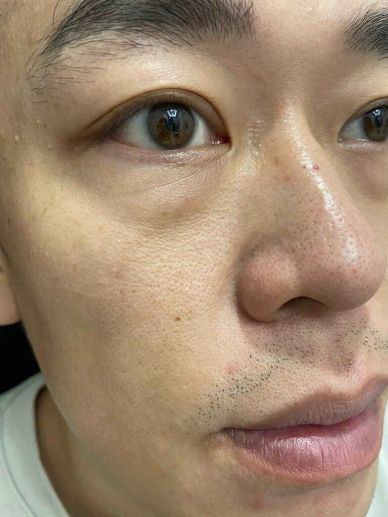 【許惠翔美學診所評價】南屯醫美消眼袋專家！絕不失敗的洢蓮絲淚溝填補 17
