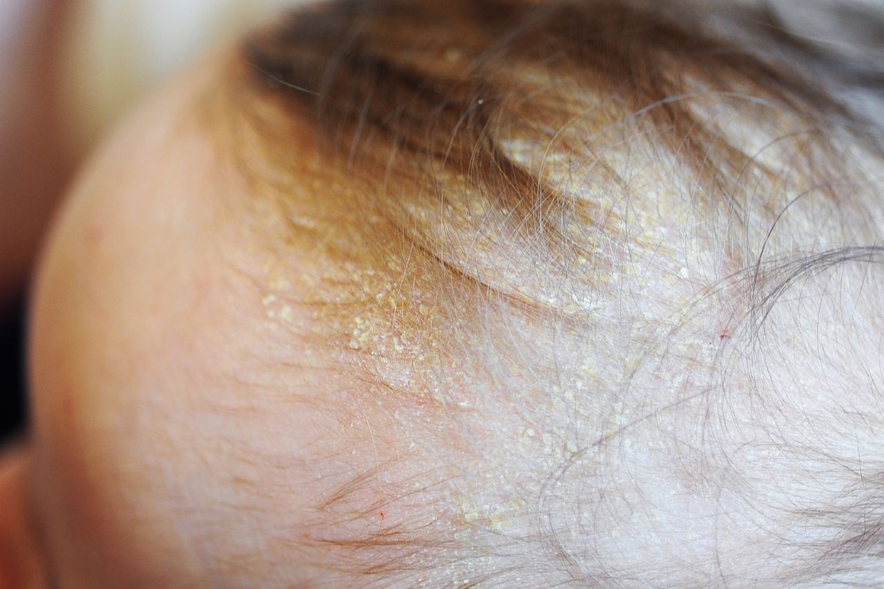 [Seborrhea dermatitis lazy bag] What are the treatment, conditioning and maintenance methods, common QA lazy bag answers all at once 1