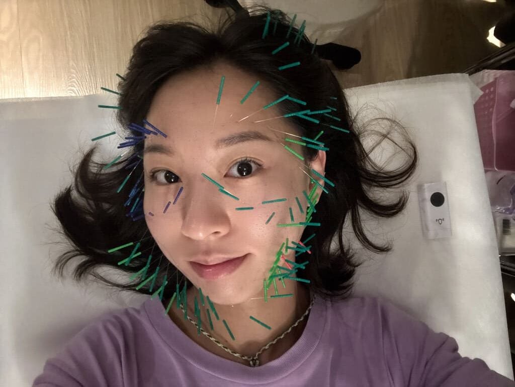 美顏針_麗馨內湖中醫診所_2025-08-02_9.